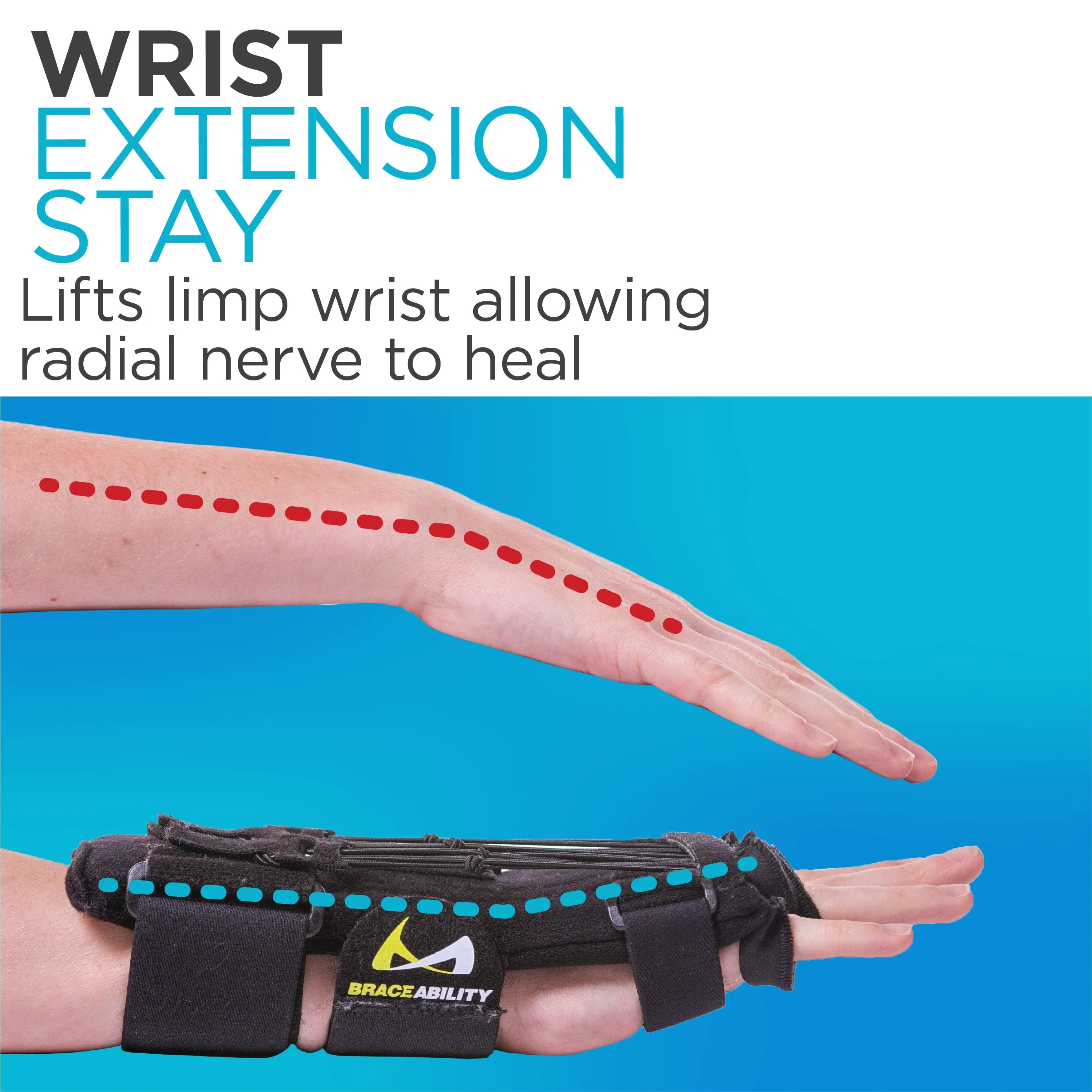 Radial Nerve Palsy Splint | Dynamic Wrist Drop & Finger Extension Brace for Saturday Night, Honeymoon & Crutch Palsy